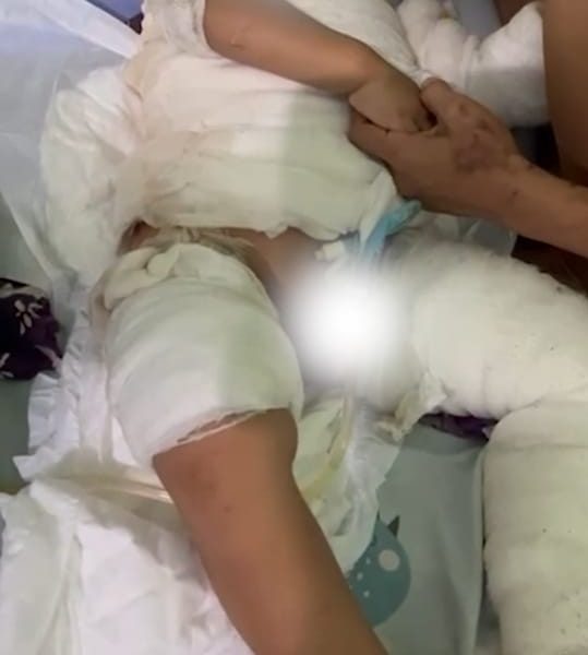 Balita Pasien Tersiram Air Panas, Warga Kurang Mampu di Tahan RSUD&nbsp;Tulungagung